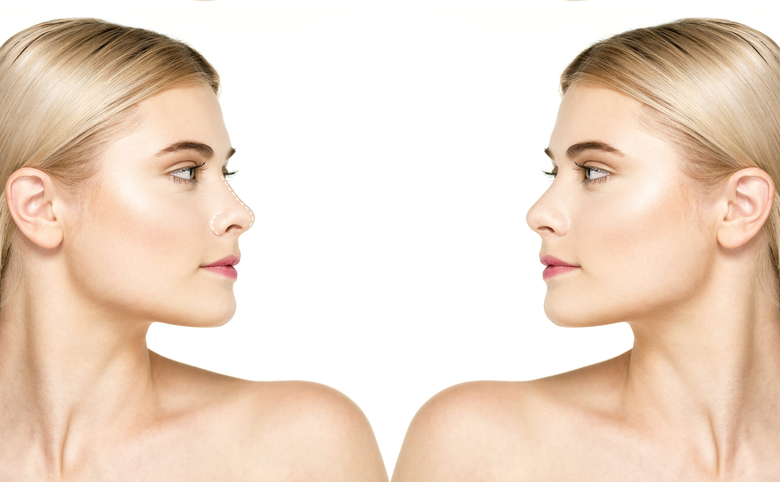 Jawline Surgery Before and After: Amazing Transformations in 2024