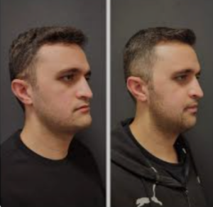 orthognathic surgery before and after