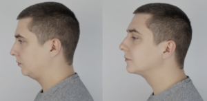 orthognathic surgery before and after