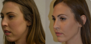 orthognathic surgery before and after