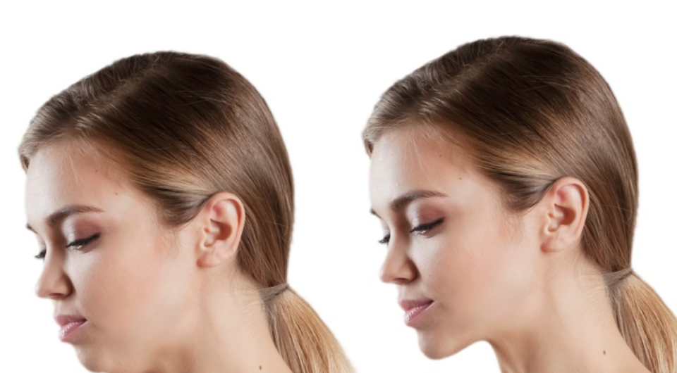 Orthognathic Surgery Before and After: 5 Stunning Results