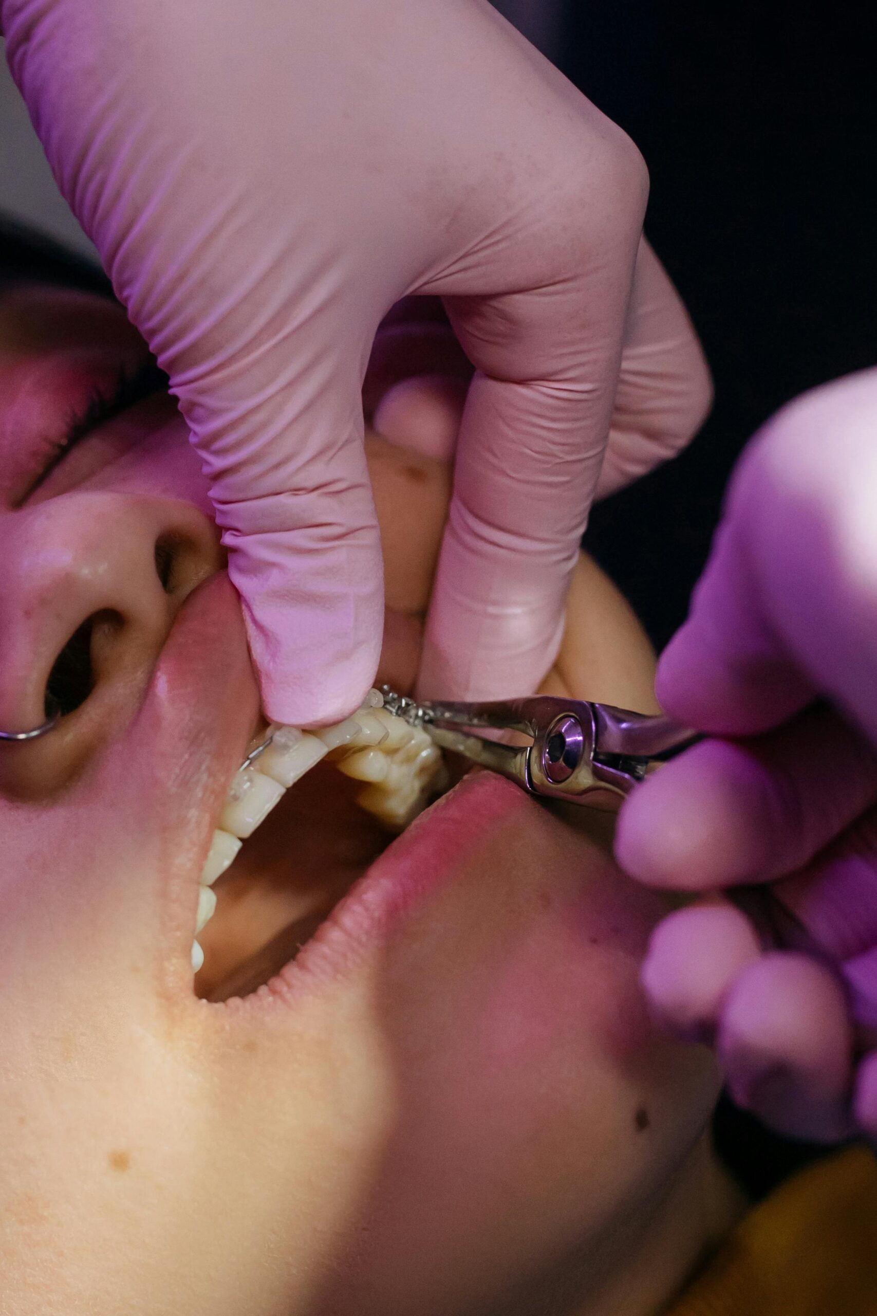 Pinhole Gum Surgery: 5 Amazing Benefits for Healthier Gums