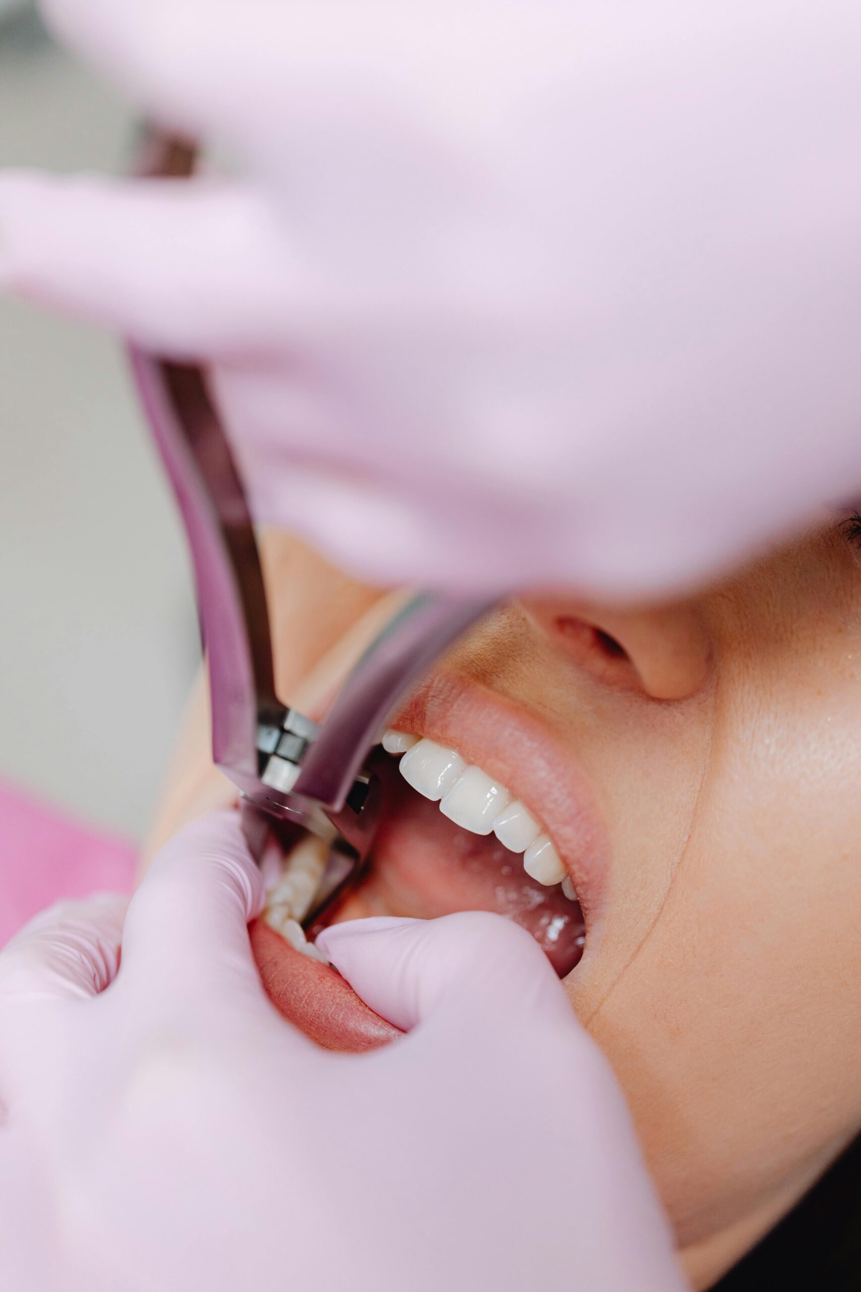 Impacted Wisdom Teeth Removal Oxnard – Top 5 Trusted Specialists