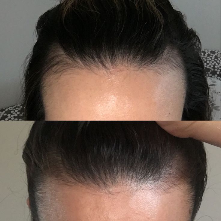 derma roller before and after
